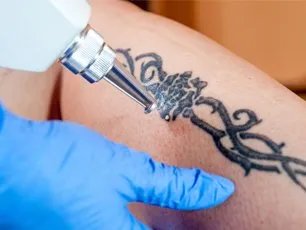 A person getting their tattoo done with a machine.